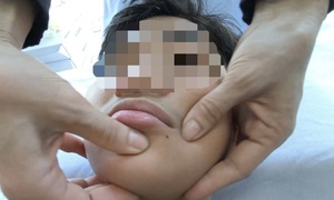 Nhiều ca nhập viện bị liệt mặt, méo miệng do rét đậm