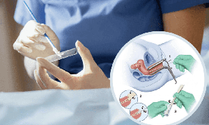 Khi nào nên làm xét nghiệm Pap để sàng lọc ung thư cổ tử cung?