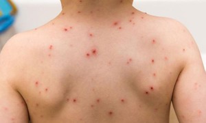 3 bệnh thường gặp ở trẻ vào mùa xuân