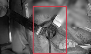 Nấm đen 'ăn' mòn xoang hàm người đàn ông khỏe mạnh