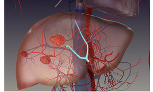 Đau tức hạ sườn, ăn kém, sút cân… cảnh giác với u máu gan