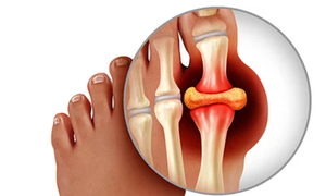 Bị gout tái đi tái lại, chữa thế nào?
