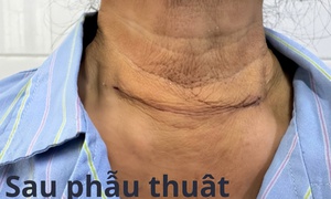Phẫu thuật thành công bướu tuyến giáp khổng lồ thòng dưới xương đòn