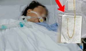 Người phụ nữ 48 tuổi phát hiện sán dây bò dài 70cm dù không có triệu chứng