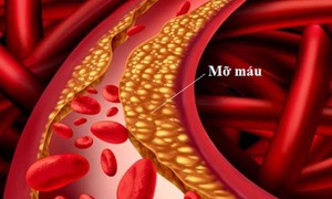 Triglyceride cao gây viêm tụy cấp nguy hiểm đe doạ tính mạng