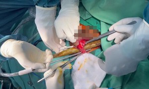 Hai thanh sắt đâm xuyên bụng, bác sĩ 4 chuyên khoa phối hợp cứu chữa