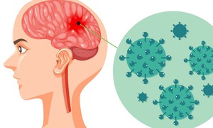 4 dấu hiệu đặc trưng cảnh báo bệnh não mô cầu cần chú ý