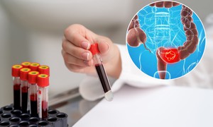 Ung thư đại trực tràng ngày càng trẻ hóa: Những dấu hiệu cảnh báo sớm