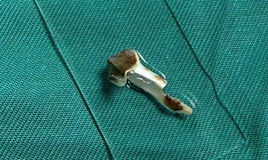 Bé 13 tuổi ho kéo dài hơn 3 năm, bác sĩ phát hiện dị vật nhựa trong phế quản