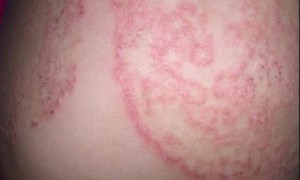 5 nguyên tắc quan trọng giúp phòng ngừa nấm da