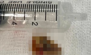 Mảnh xương 2 cm nằm sâu trong phế quản, gây tắc phổi và nhiều ổ mủ
