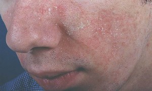 Viêm da tiết bã có lây không?