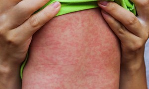 Mỹ: Bang New York ban bố tình trạng khẩn cấp do bệnh sởi