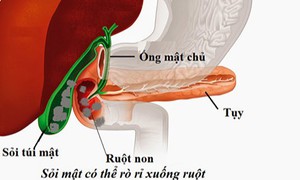 Sỏi túi mật khi nào cần mổ cấp cứu?