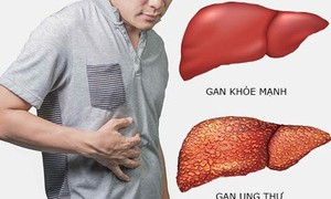 Bí quyết giúp giảm nguy cơ ung thư gan