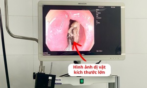 Lấy xương gà kích thước lớn mắc kẹt trong thực quản bệnh nhân