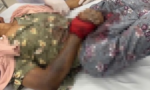 Tự chữa sau khi bị rắn độc cắn, một phụ nữ ở Lâm Đồng nguy kịch