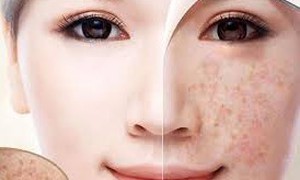 Nhận diện thủ phạm gây đốm đồi mồi trên da