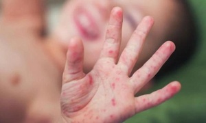 Lâm Đồng giám sát người tiếp xúc gần sau ca bệnh viêm màng não mô cầu