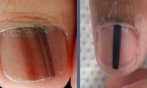 Sọc sẫm màu trên móng tay, móng chân là biểu hiện của bệnh gì?