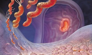 Viêm loét dạ dày – tá tràng: Dùng thuốc đúng cách để bảo vệ niêm mạc