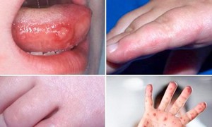 Trẻ mắc tay chân miệng chỉ sốt, loét miệng, không có nhiều mụn nước vẫn có nguy cơ diễn biến nặng nhanh chóng