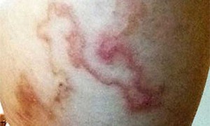 Bệnh ký sinh trùng nhiều người dương tính khi xét nghiệm ở Khánh Hòa nguy hiểm mức nào nếu không điều trị sớm?