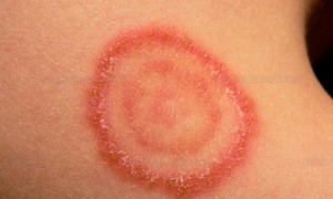 Cảnh giác nấm da lây từ chó, mèo