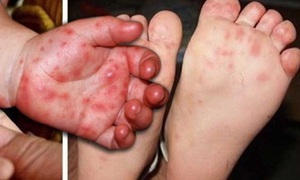 Tay chân miệng ở Khánh Hòa tăng gấp 4 lần năm ngoái, bác sĩ khuyến cáo điều phụ huynh cần làm ngay