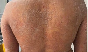 Dùng sai thuốc, nấm da lan toàn thân, ngứa dữ dội