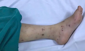 Bé 11 tuổi tử vong do não mô cầu thể tối cấp tại TPHCM