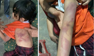 Bé gái lớp 2 bị bạn đánh bầm tím người