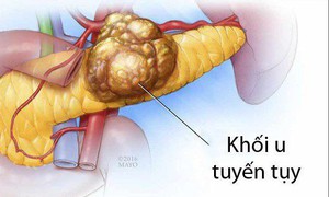 Các phương pháp điều trị u đầu tụy