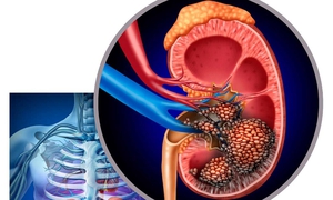 Đau vùng hông lưng, người phụ nữ phát hiện khối u thận 