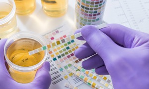 Cảnh giác đi tiểu liên tục dù không uống nhiều nước: đừng nhầm tưởng là suy thận