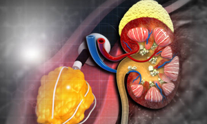 Phát hiện loại thuốc mới đầy hứa hẹn trị bệnh thận hiếm nguy hiểm