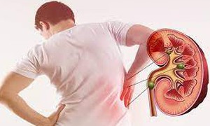 Sỏi thận có thể tự đào thải trong bao lâu, khi nào cần can thiệp?