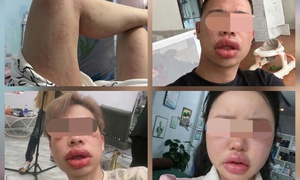 Sưng mắt, môi sau khi ăn bánh trứng kiến: Đặc sản hay 'thủ phạm'?