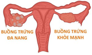Phụ nữ mắc hội chứng buồng trứng đa nang có mang thai được không?