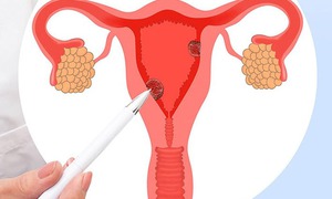 Hội chứng buồng trứng chuyển hóa đa nội tiết - tên gọi mới của hội chứng buồng trứng đa nang