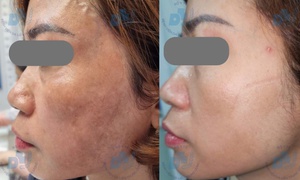 Bác sĩ chỉ rõ lý do nhiều người trị nám tốn kém nhưng vẫn tái phát