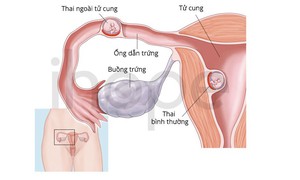 Hiếm gặp: Vừa có thai trong tử cung vừa có thai ngoài tử cung