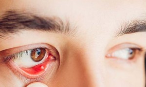 Nguyên nhân gây cộm mắt và cách khắc phục