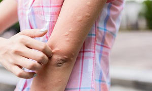 Mề đay dễ bùng phát khi nắng nóng: 3 cách làm giảm ngứa, dịu da