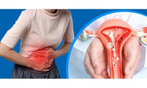 7 dấu hiệu thường gặp của lạc nội mạc tử cung chị em nên chú ý