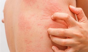 Da nổi mẩn đỏ, ngứa: dấu hiệu dị ứng hay cảnh báo bệnh lý tiềm ẩn?