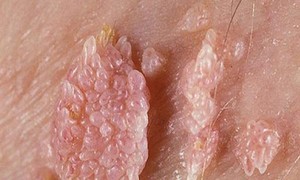 Dấu hiệu nhận biết sớm bệnh sùi mào gà ở phụ nữ