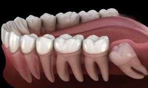 Những biến chứng thường gặp khi mọc răng khôn không thể xem nhẹ