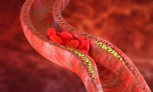 Thay đổi lối sống giúp kiểm soát cholesterol cao, giảm nguy cơ bệnh tim mạch