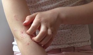 Dấu hiệu ngứa do ký sinh trùng
